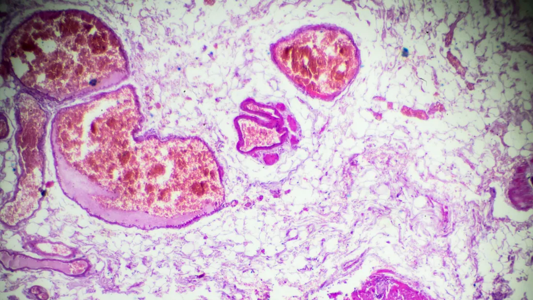 Adenocarcinoma de Pulmão: Diagnóstico, Tipos e Tratamento · imagem ilustrativa