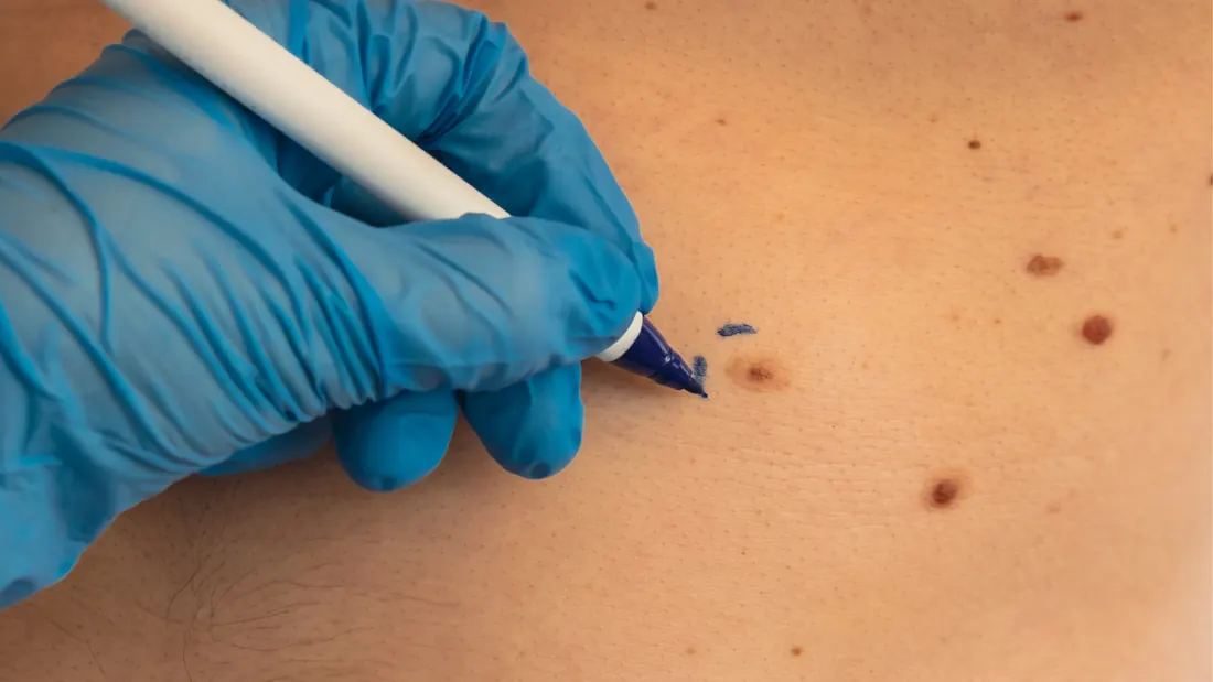 Câncer de Pele Não Melanoma: Carcinoma Basocelular, Espinocelular e Tratamento · imagem ilustrativa