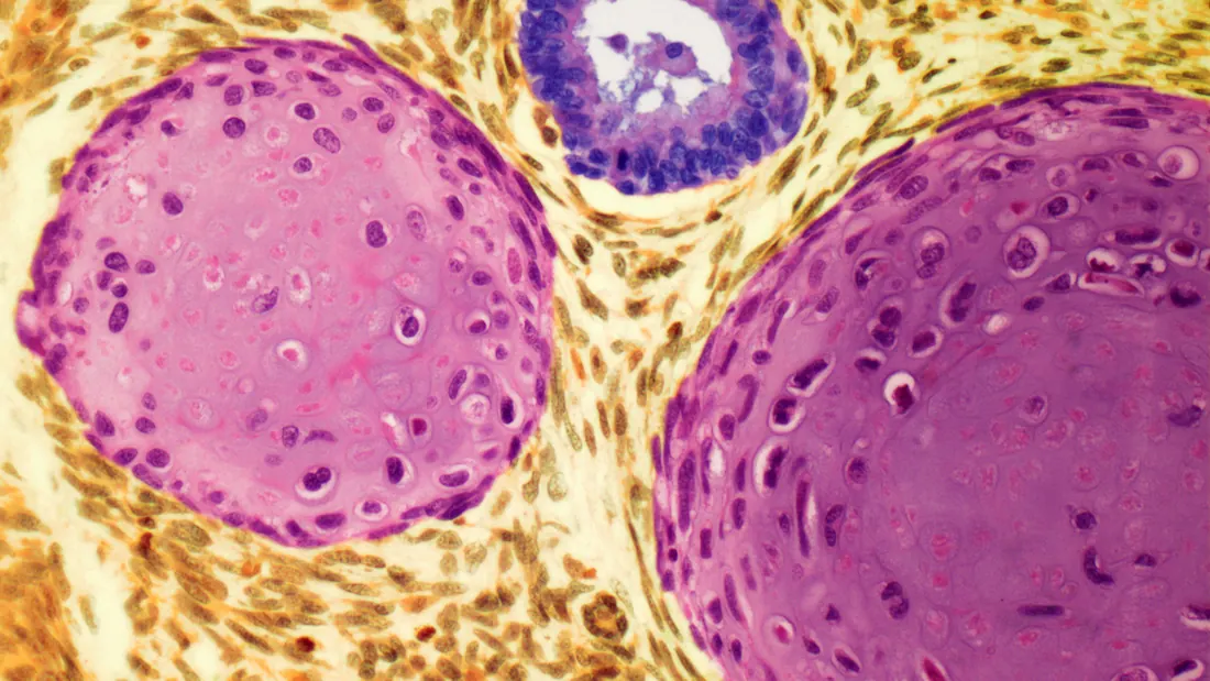Câncer de Testículo: 4 Fatores de Risco, Sintomas e Tratamento · imagem ilustrativa