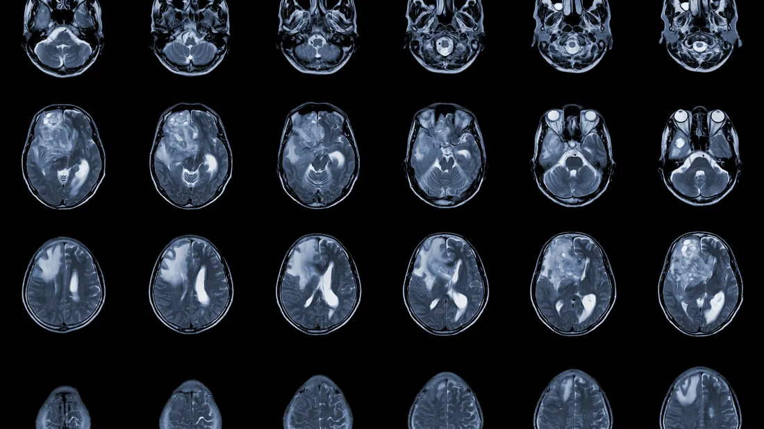Glioblastoma: 4 Características Moleculares, Sintomas e Tratamento do Tumor Cerebral · imagem ilustrativa
