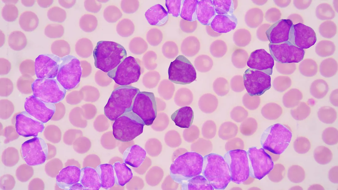 Leucemia: 4 Tipos, Sintomas e Tratamento Oncológico · imagem ilustrativa
