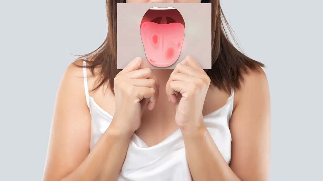 Mucosite Oral em Oncologia: Causas, Graus de Gravidade, Prevenção e Tratamento · imagem ilustrativa