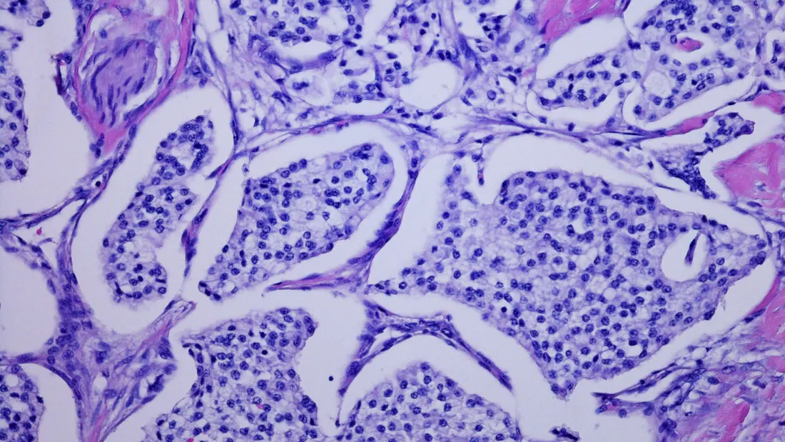 Tumor Neuroendócrino: O Que É, 4 Tipos e Tratamento · imagem ilustrativa