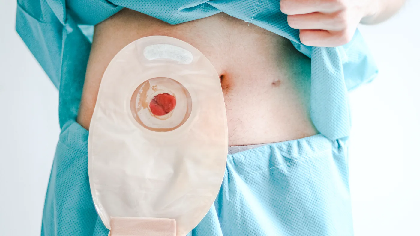 Bolsa de colostomia sobre a parede abdominal · imagem ilustrativa