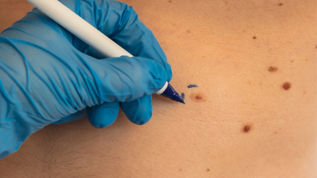 Câncer de Pele Não Melanoma | Dr. Michel Chebel