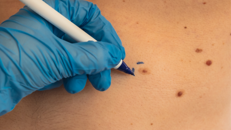 Câncer de Pele Não Melanoma | Dr. Michel Chebel