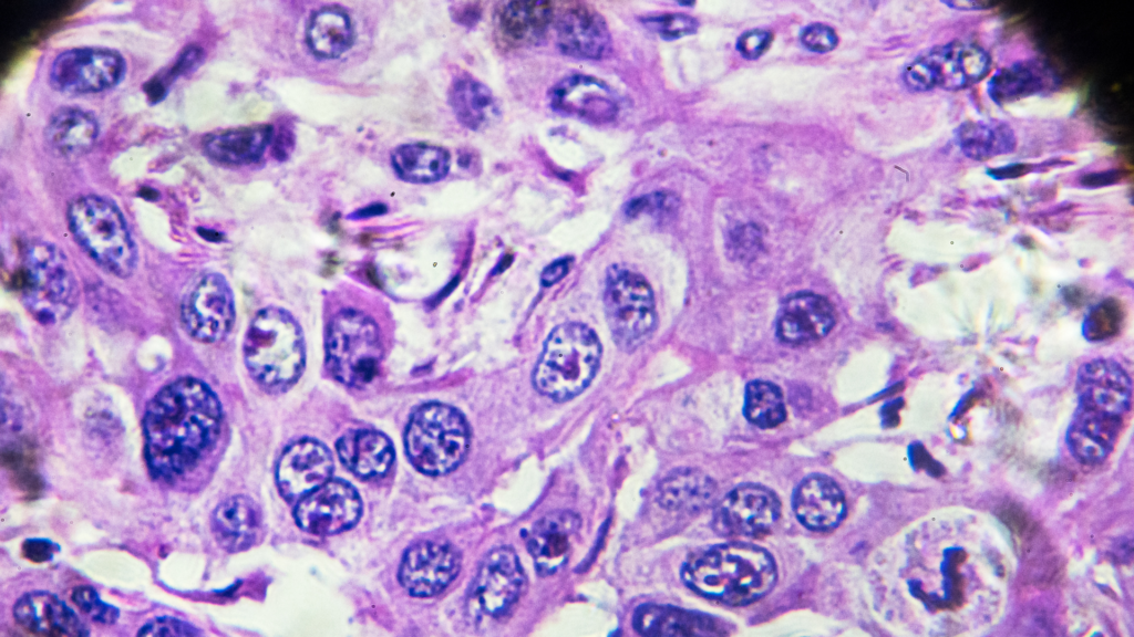 Carcinoma Hepatocelular | Dr. Michel Chebel