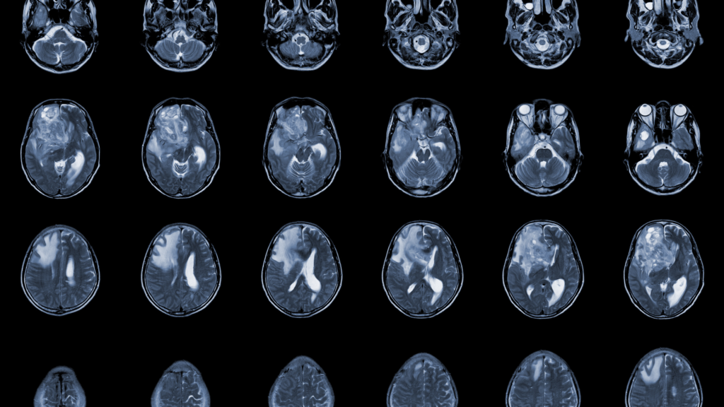 Glioblastoma | Dr. Michel Chebel