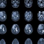 Glioblastoma | Dr. Michel Chebel