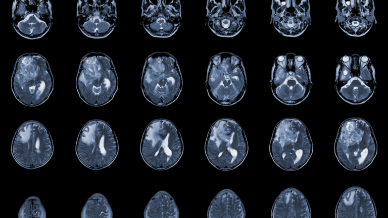 Glioblastoma | Dr. Michel Chebel