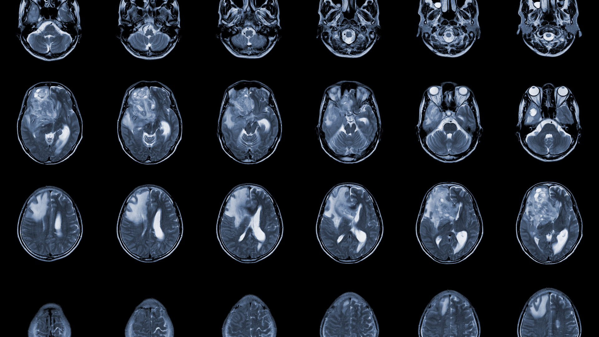 Glioblastoma | Dr. Michel Chebel